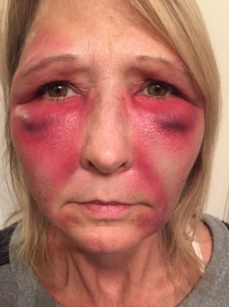 ⚠️ The Risks of Botox