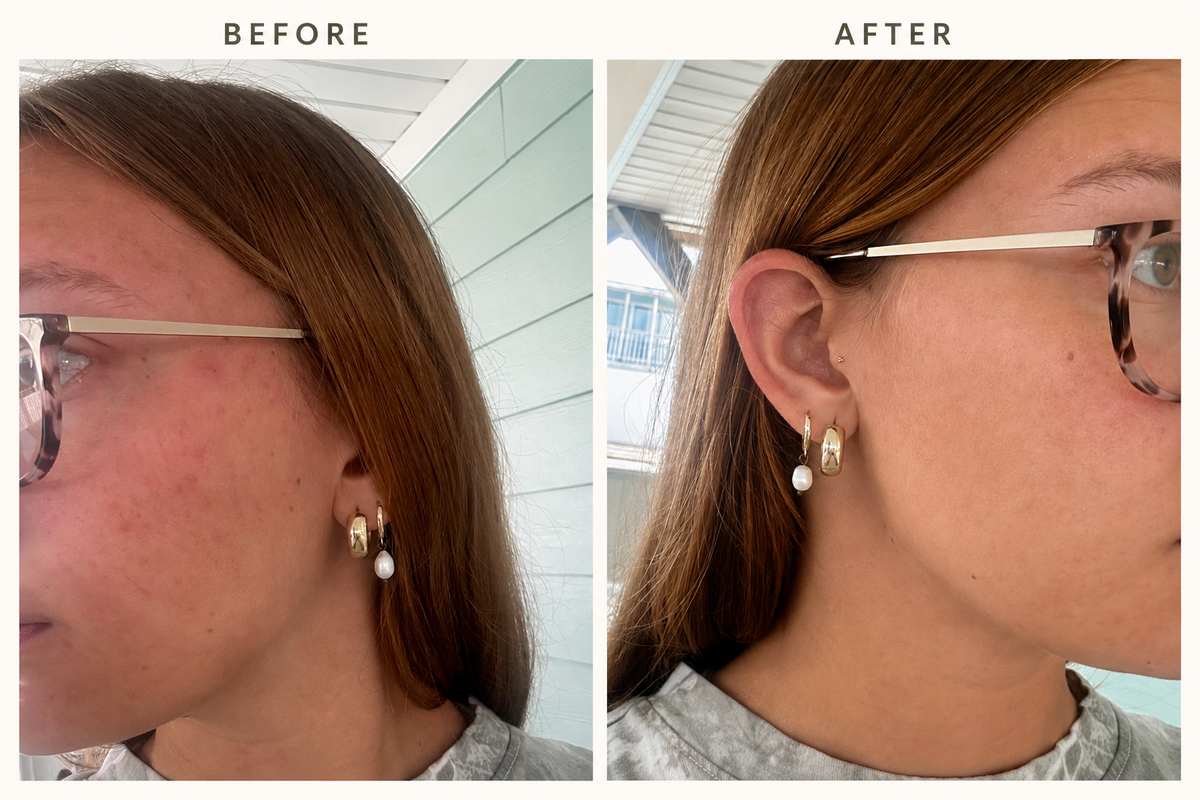 Anti-Blemish Tallow Cream